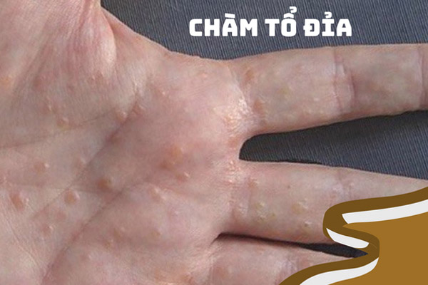 Các triệu chứng chàm tổ đỉa thường tập trung ở lòng bàn tay